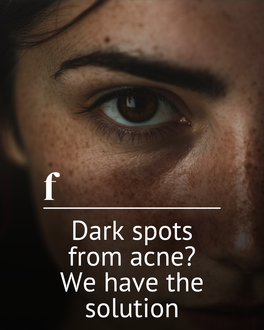 Dark Spots From Acne? We Have The Solution